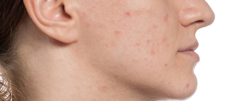 什么因素会导致粉刺滋生 脸上冒粉刺的原因