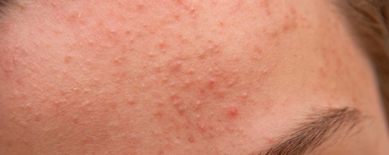 寡肽-3对皮肤的作用  寡肽-3对肌肤的作用效果有哪些